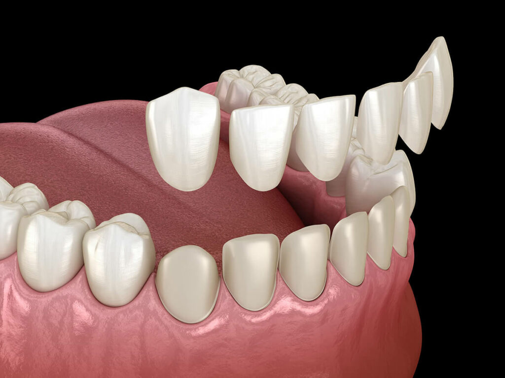 Illustration of dental veneers being placed onto a bottom row of teeth