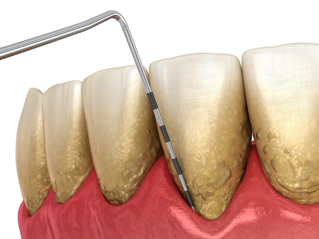 illustration of periodontal disease