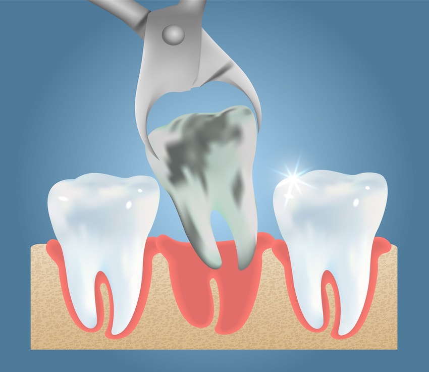 Illustration of a rotten tooth being extracted from between two healthy, white teeth