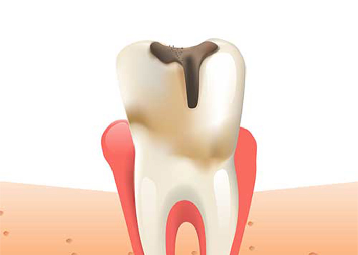 illustration of a tooth with decay, indicating a cavity is present